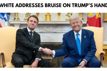 trump bruised hand